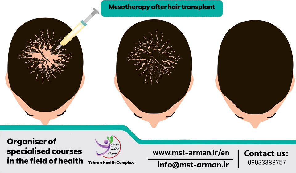 Mesotherapy after hair transplant