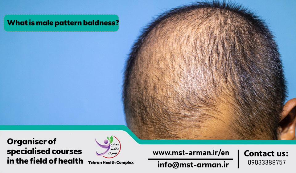What is male pattern baldness?