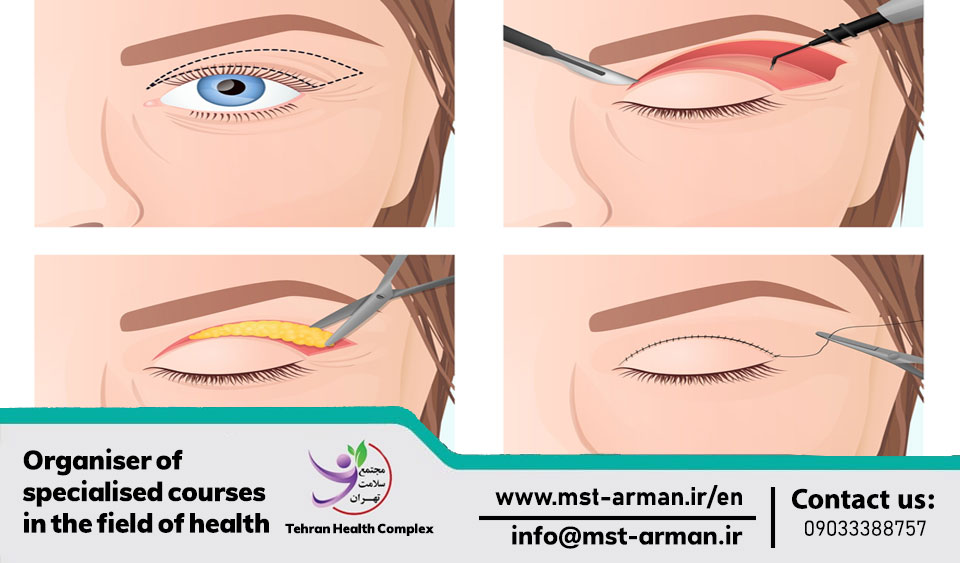 what are the upper blepharoplasty surgery techniques?