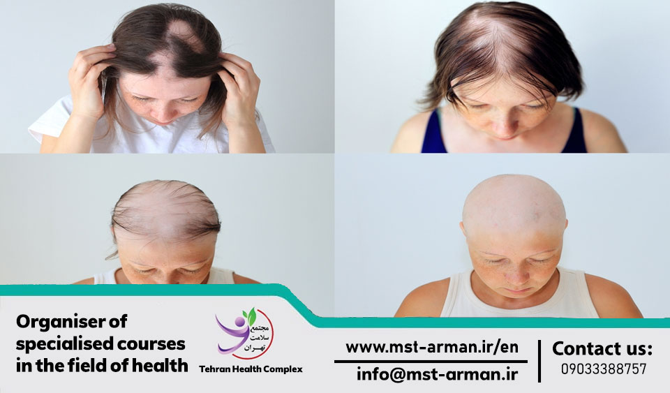 Stages of hair loss in women