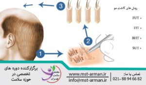 Hair and eyebrow transplant methods | روش های کاشت مو و ابرو