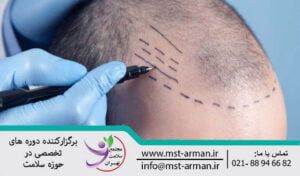 عوارض جانبی کاشت مو | Complications of hair transplant
