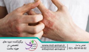 Treatment of atopic eczema | درمان اگزما آتوپیک 
