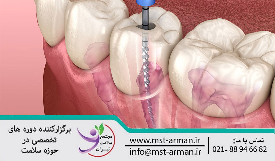 Root-canal-therapy | درمان ریشه دندان