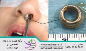 Injury to a foreign object in the nose | جراحت با اجسام خارجی چشم و بینی 