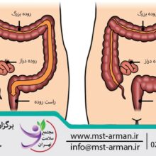 irritable bowel syndrome | سندروم روده تحریک پذیر | علائم روده تحریک پذیر | راه های درمان سندروم روده تحریک پذیر