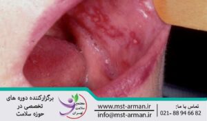 Oral soft tissue tumor | تومور بافت های نرم دهان