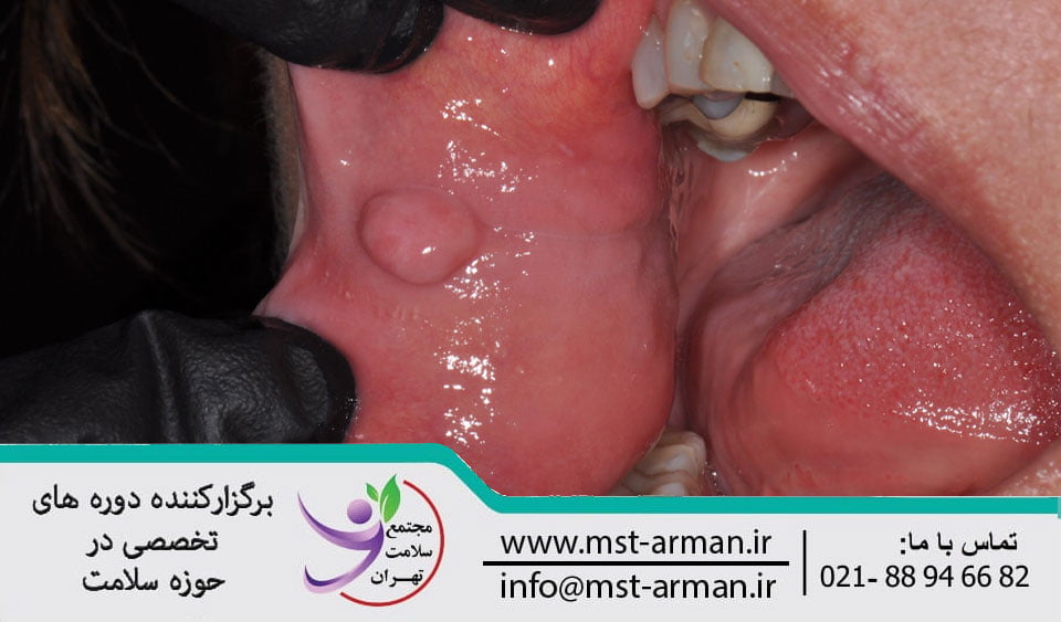 Oral tissue tumors |تومور های بافت نرم دهان