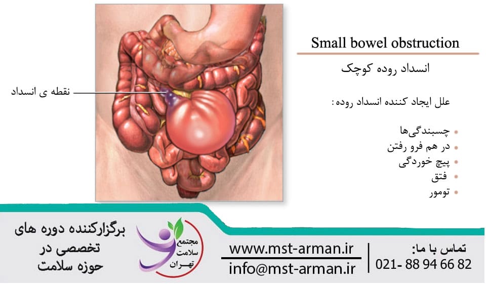 Small bowel obstruction | انسداد روده کوچک