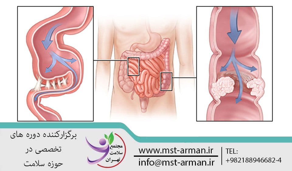 Small bowel obstruction | انسداد روده کوچک تحت چه عواملی بوجود می آید | انسداد روده کوچک چیست | راه های درمان انسداد روده | تدابیر پرستاری برای انسداد روده کوچک