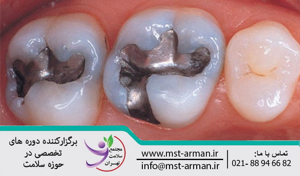 What is Dental Amalgam | آمالگام دندانی چیست