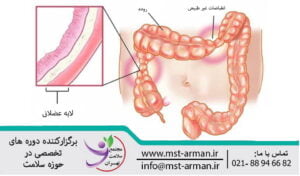 irritable bowel syndrome | سندروم روده تحریک پذیر