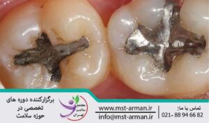 Dental amalgam | امالگام دندانی چیست