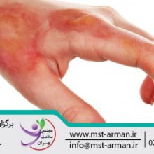 Burns and its types | تعریف انواع سوختگی | شدت سوختگی | تعریف سوختگی | Definition of burns
