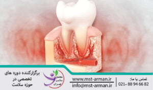 Dental pulpotomy | پالپوتومی دندان چیست