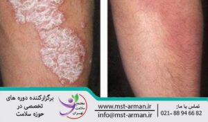 Disseminated sheet dermatitis | درماتیت ورقه‌ای منتشر و عوامل ایجاد آن