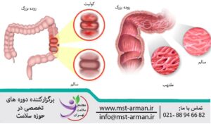 Inflammatory bowel disease | بیماری التهابی روده چیست