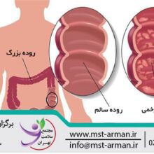 Inflammatory bowel disease | بیماری التهابی روده | انواع التهاب روده | کولیت روده | علائم بیماری التهاب روده | بیماری التهاب روده بزرگ چیست