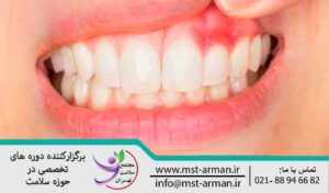 Invasive periodontitis | پریودنتیت مهاجم