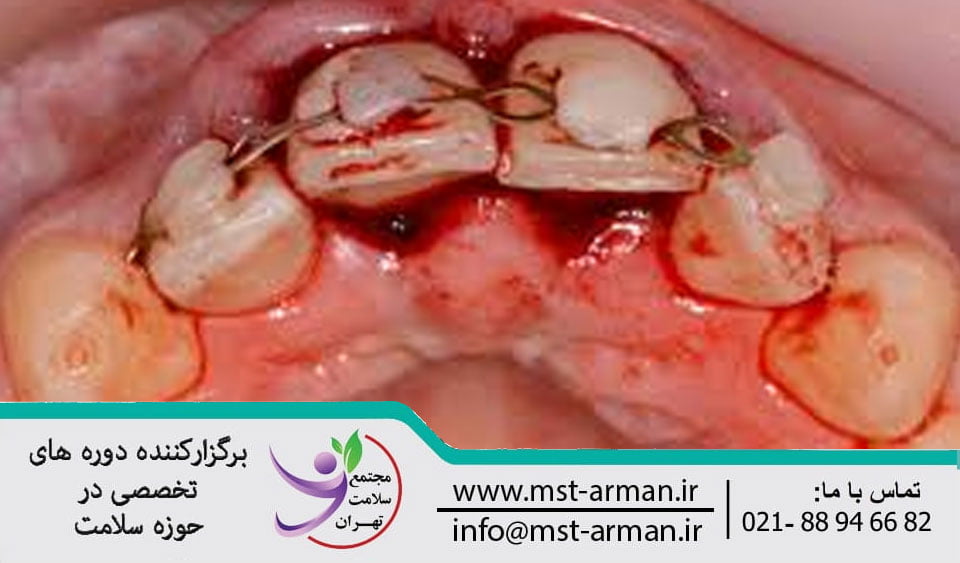 Symptoms of dental intrusion | علائم اینتروژن دندان