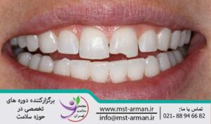 Tooth fracture | درمان شکستگی دندان