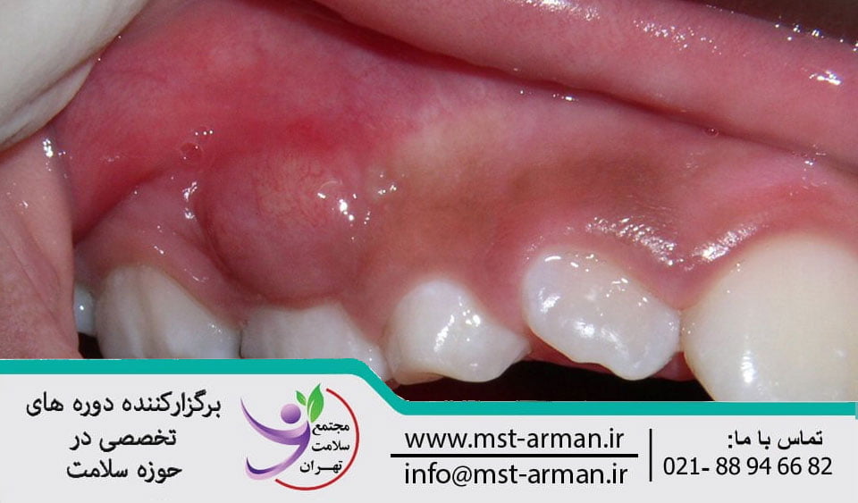 Treatment of periodontal abscess |درمان آبسه پریودنتال