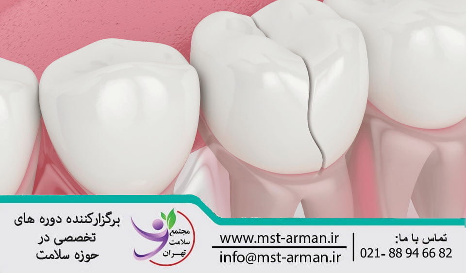 Treatment of tooth root fractures | درمان شکستگی دندان