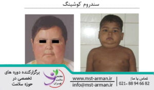 what is Cushing's syndrome |  سندروم کوشینگ چیست