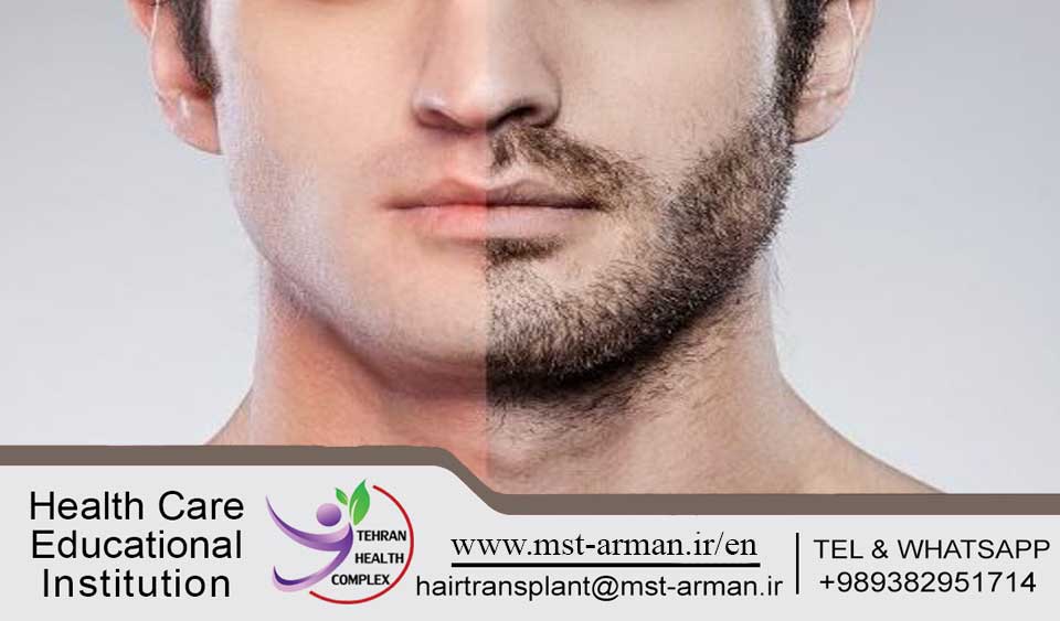 Beard and Mustache Implantation