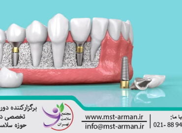دوره ایمپلنت در دندانپزشکی | Implant in dentistry