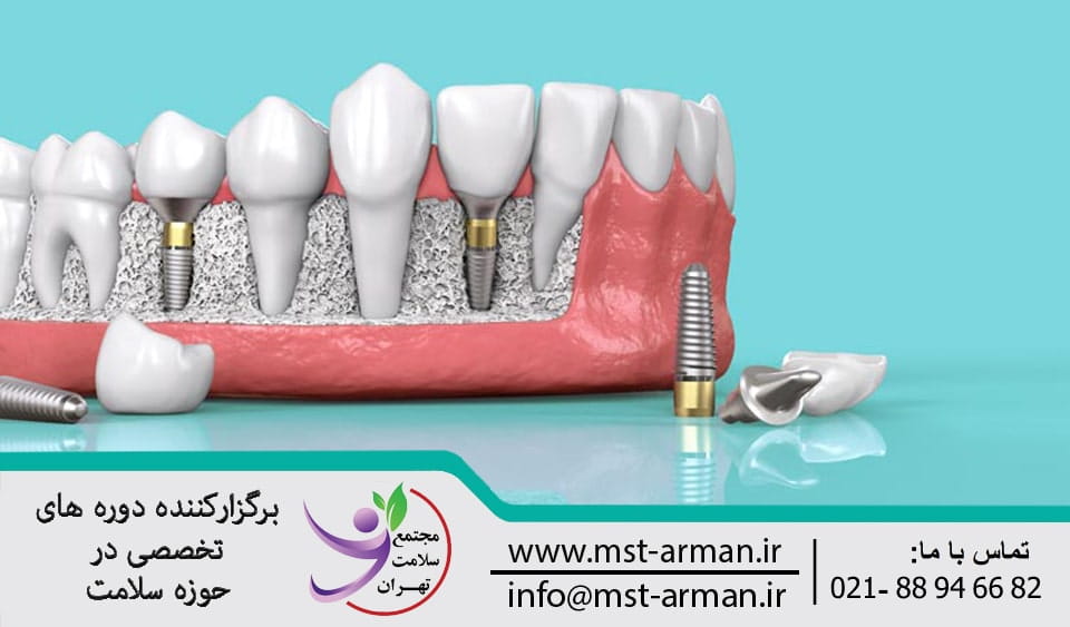 دوره ایمپلنت در دندانپزشکی | Implant in dentistry