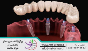 Dental implants | ایمپلنت دندان