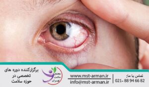 The most common eye disorders | شایع ترین ناراحتی های چشم | بیماری گلوکوم چشم