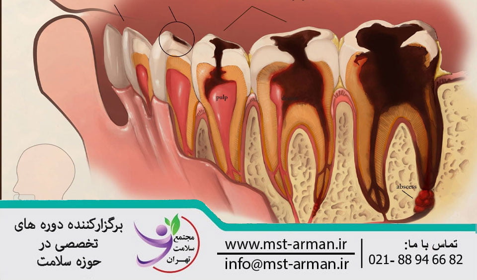 Tooth Decay | پوسیدگی دندان