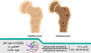 بیماری های اسکلتی | Skeletal diseases | Osteoporosis | پوکی استخوان
