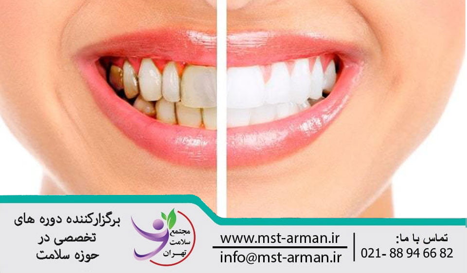 Tooth bleaching | بلیچینگ دندان