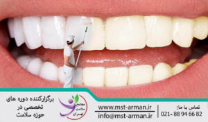 Tooth- bleaching | بلیچینگ دندان