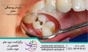 Treatment of tooth decay | درمان پوسیدگی دندان