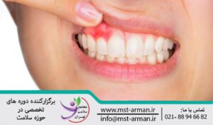 Dental abscess | طبقه بندی آبسه های دندان