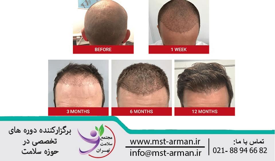 Recovery steps after hair transplant | مراحل بهبود بعد از عمل کاشت مو