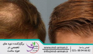 Artificial hair transplant | کاشت موی مصنوعی 