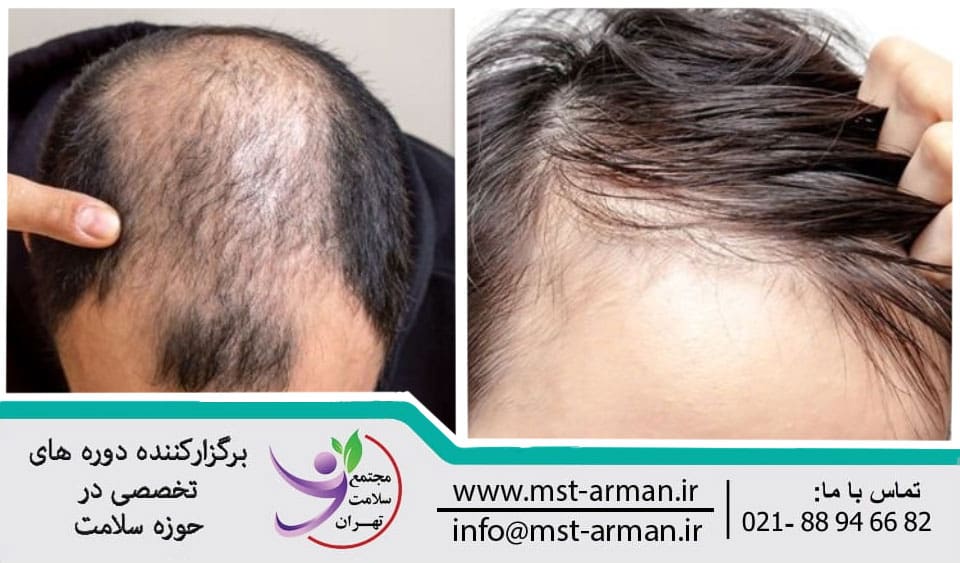 Asymmetry of hair transplant | عدم تقارن در کاشت مو