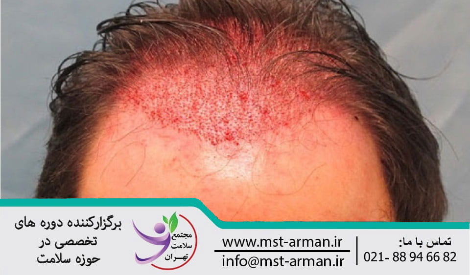 Bleeding during hair transplantation | خونریزی بعد از عمل کاشت مو