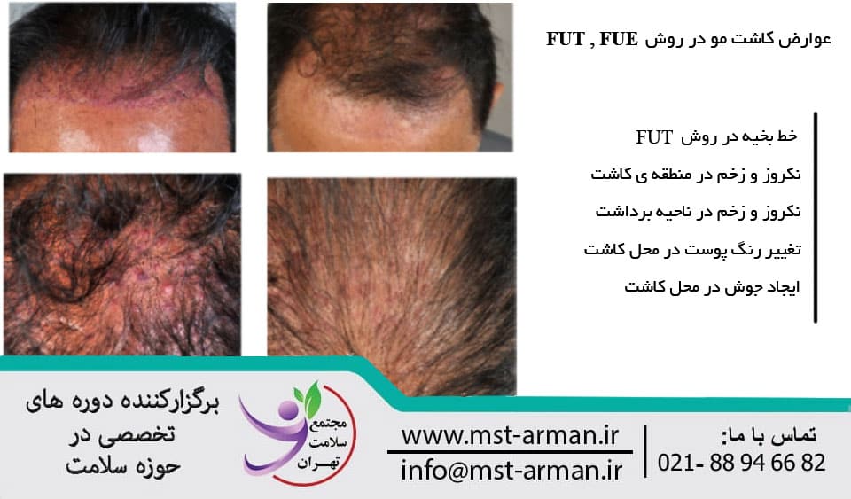 Dermatitis after hair transplantation | عوارض کاشت مو