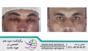 Facial swelling after hair transplantation | تورم صورت بعد از کاشت مو