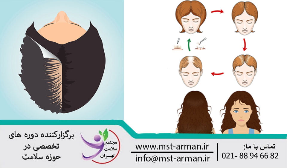 Article on hair transplant in women | کاشت مو در خانم ها