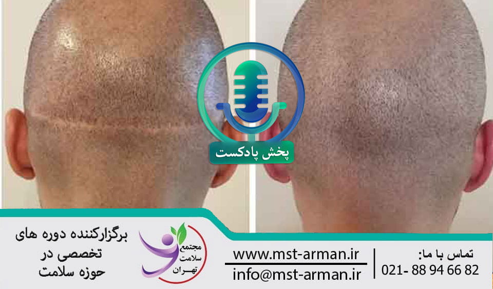 Protrusion and indentation in the hair transplant area | برامدگی ها و تورفتگی پوست سر ناحیه کاشت مو