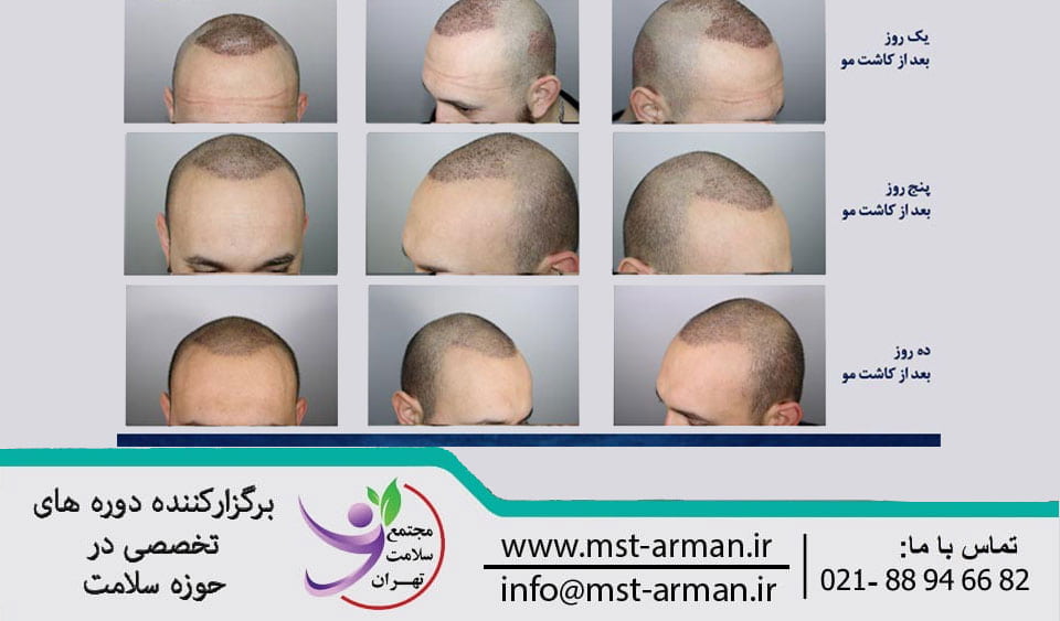 Recovery steps after hair transplant | مراحل بهبود بعد از کاشت مو