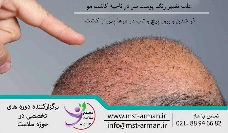 Scalp discoloration in the hair transplant area | تغییر رنگ پوست در ناحیه کاشت مو