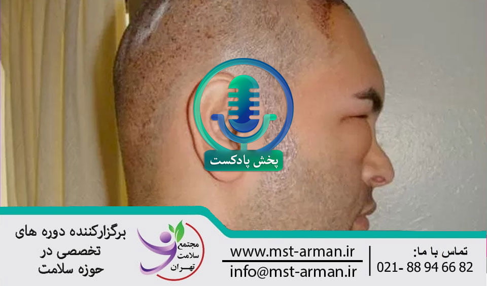 Swelling of the face after implantation | تورم صورت بعد از عمل کاشت مو